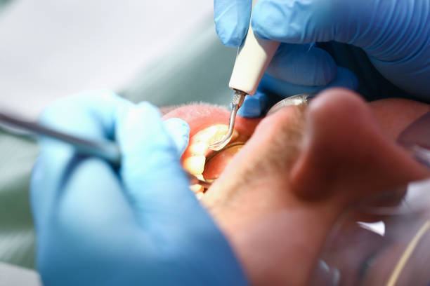 Tooth Infection Emergency Dentist in SD
